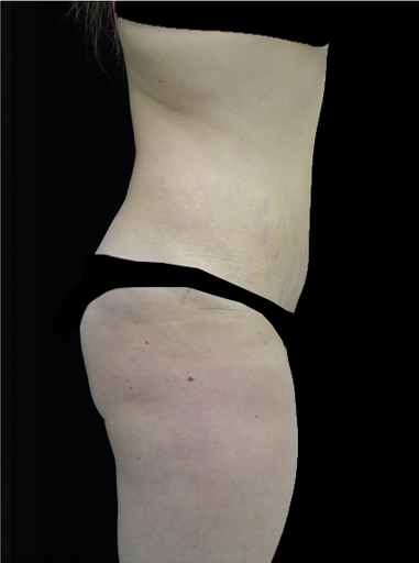 Lipoabdominoplasty Before & After Patient #15132
