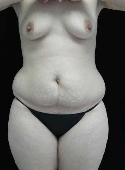 Mommy Makeover Before & After Patient #15267