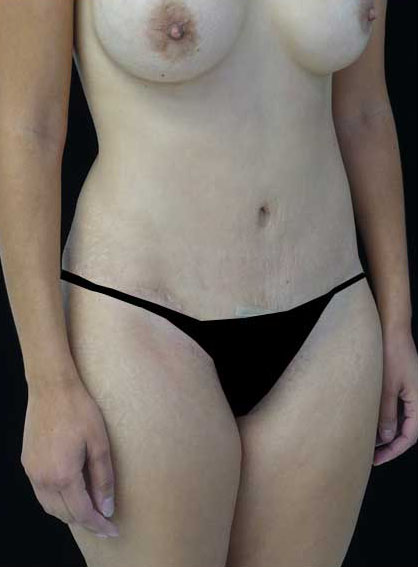 Mommy Makeover Before & After Patient #15267