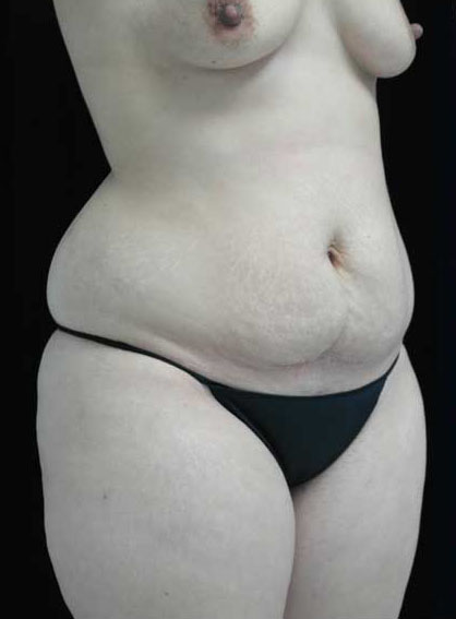 Mommy Makeover Before & After Patient #15267
