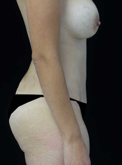 Mommy Makeover Before & After Patient #15267