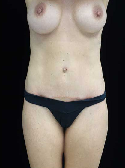 Mommy Makeover Before & After Patient #15274