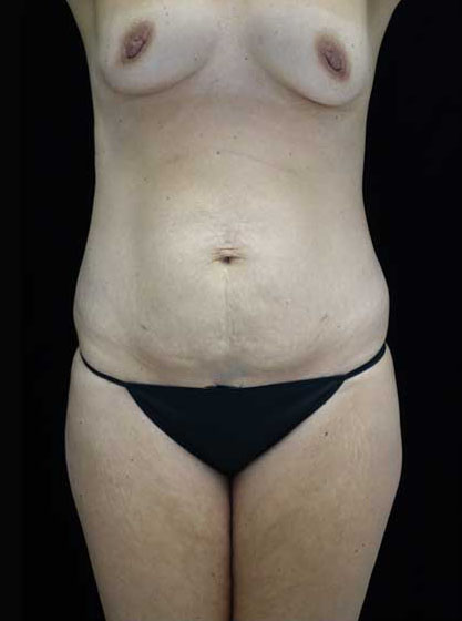 Mommy Makeover Before & After Patient #15274