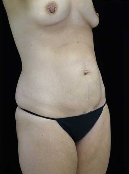 Mommy Makeover Before & After Patient #15274