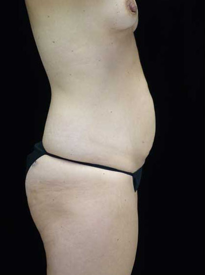 Mommy Makeover Before & After Patient #15274