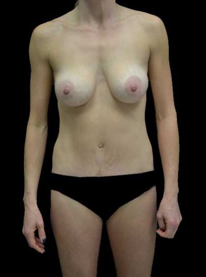 Mommy Makeover Before & After Patient #15301
