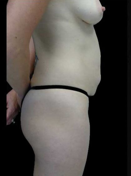 Mommy Makeover Before & After Patient #15301