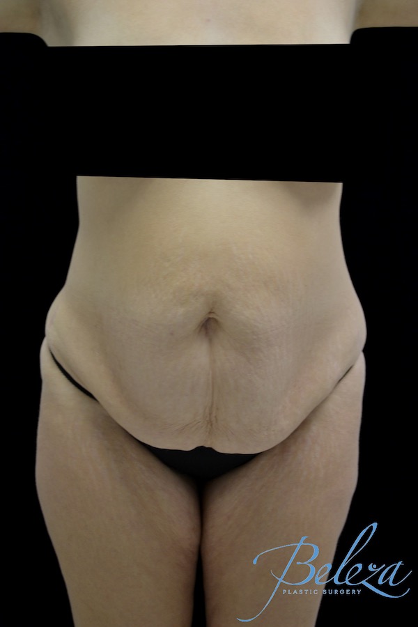 Mommy Makeover Before & After Patient #15281