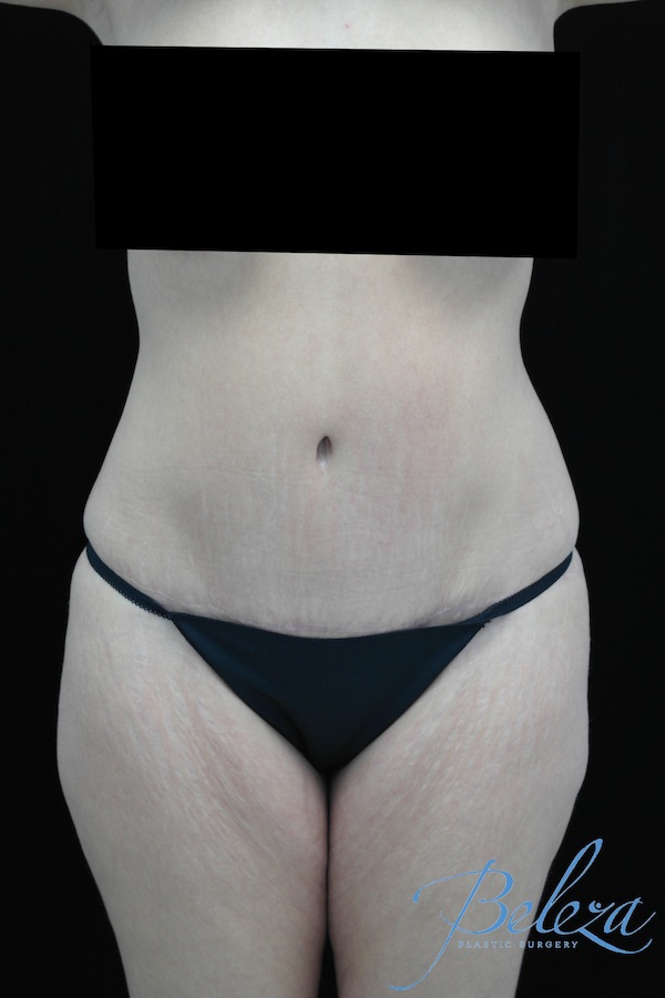 Mommy Makeover Before & After Patient #15281