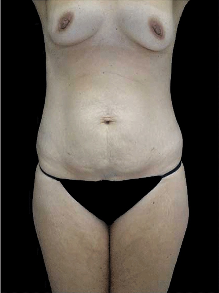 Mommy Makeover Before & After Patient #15274