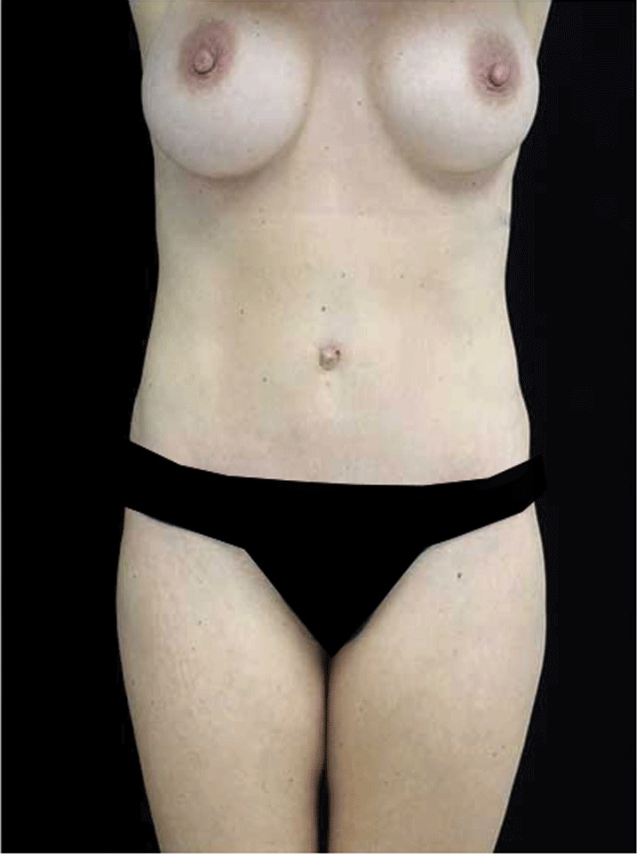 Mommy Makeover Before & After Patient #15274