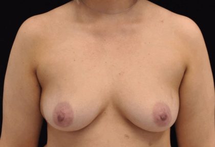 Mommy Makeover Before & After Patient #15274