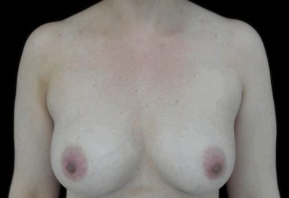 Mommy Makeover Before & After Patient #15274