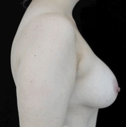 Mommy Makeover Before & After Patient #15274