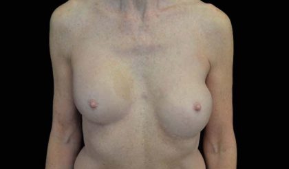 Breast Revision Before & After Patient #14719