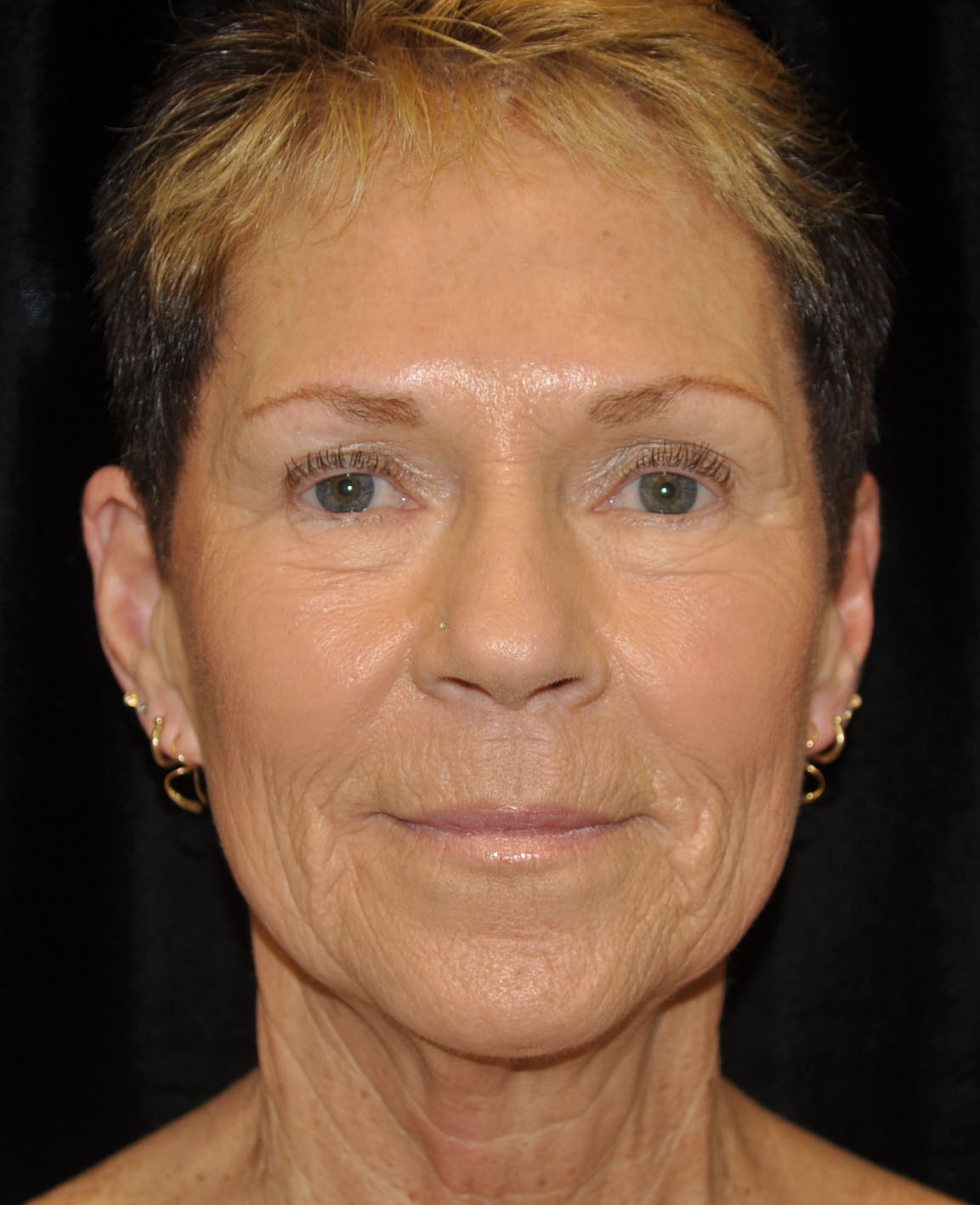 Liquid Facelift Before & After Patient #14841