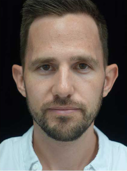 Otoplasty Before & After Patient #15241