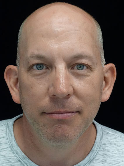 Otoplasty Before & After Patient #15244