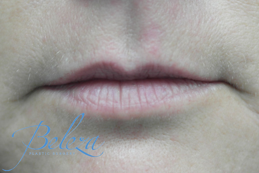 Lip Augmentation - Fillers Before & After Patient #14857