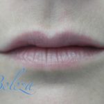 Lip Augmentation - Fillers Before & After Patient #14857
