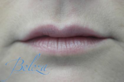 Lip Augmentation - Fillers Before & After Patient #14857