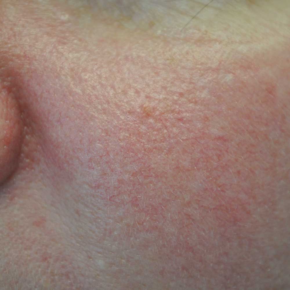 Intensive Pulse Light (IPL) Before & After Patient #14793