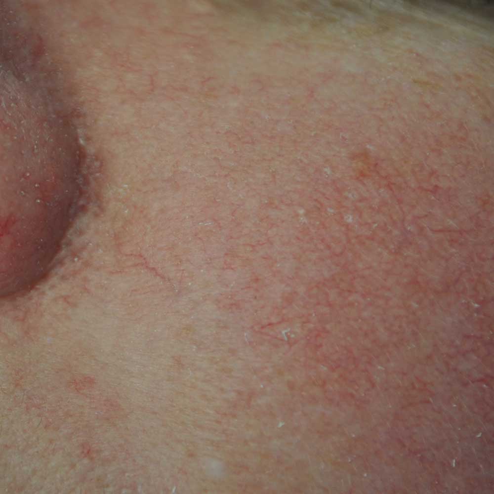 Intensive Pulse Light (IPL) Before & After Patient #14793