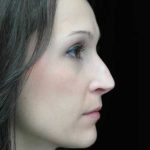 Rhinoplasty Before & After Patient #15195