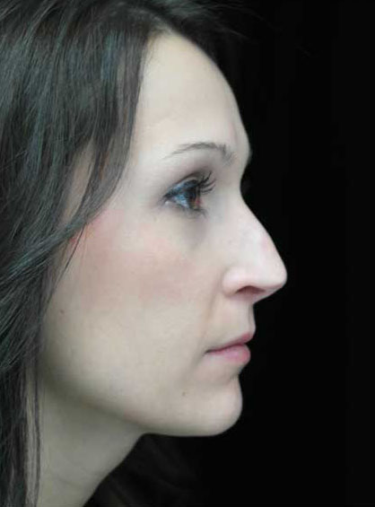 Rhinoplasty Before & After Patient #15195