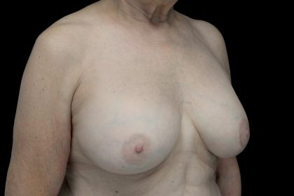 Breast Augmentation (Implants) Before & After Patient #14231