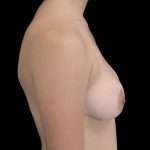 Breast Augmentation (Implants) Before & After Patient #14098