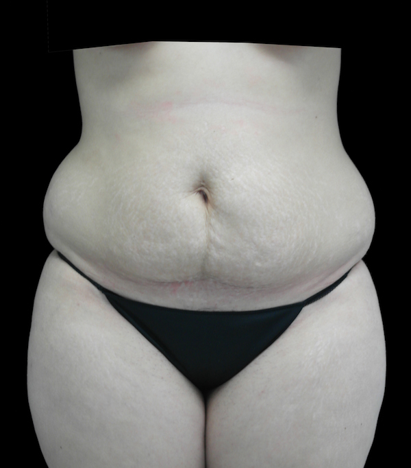Mommy Makeover Before & After Patient #15267