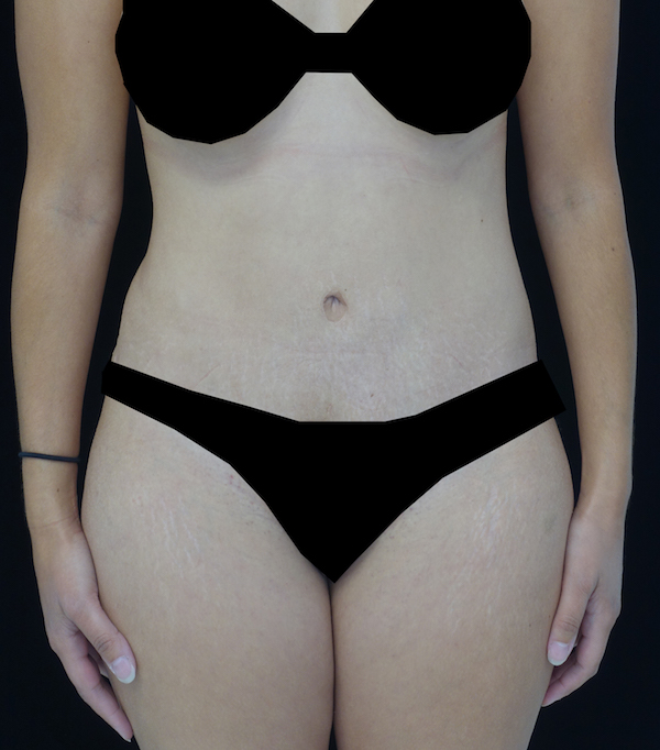 Mommy Makeover Before & After Patient #15267