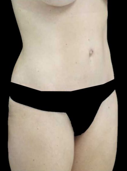 Lipoabdominoplasty Before & After Patient #15145
