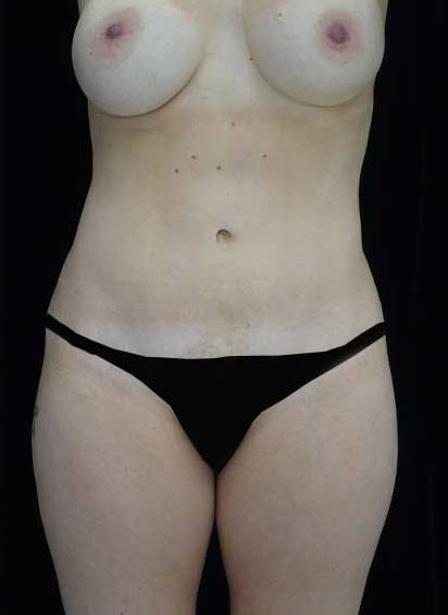 Tummy Tuck Before & After Patient #14992