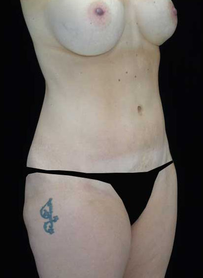Tummy Tuck Before & After Patient #14992