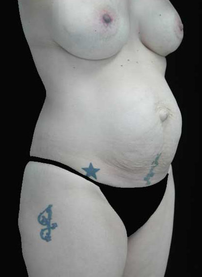 Tummy Tuck Before & After Patient #14992