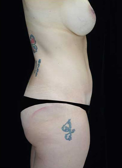 Tummy Tuck Before & After Patient #14992