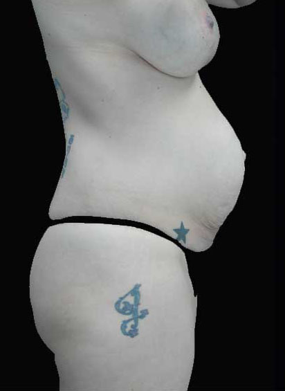 Tummy Tuck Before & After Patient #14992