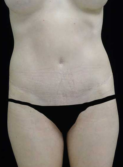 Tummy Tuck Before & After Patient #15062
