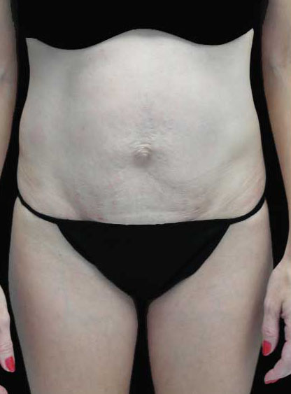 Tummy Tuck Before & After Patient #15062
