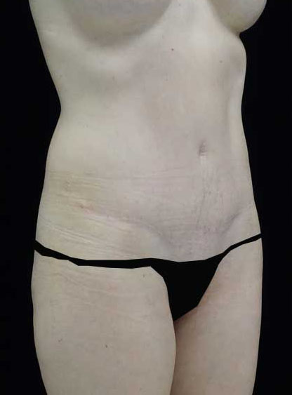 Tummy Tuck Before & After Patient #15062