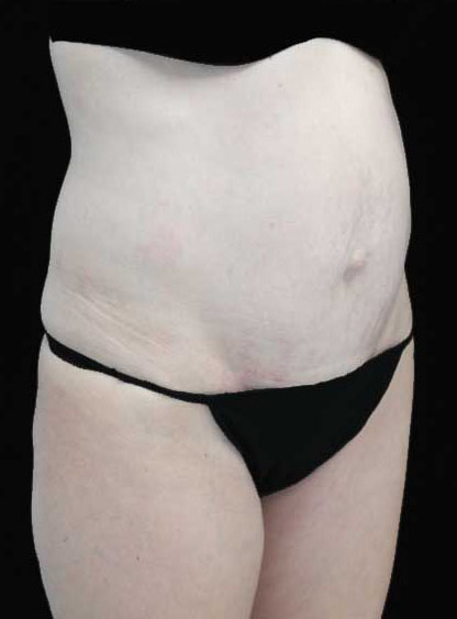 Tummy Tuck Before & After Patient #15062