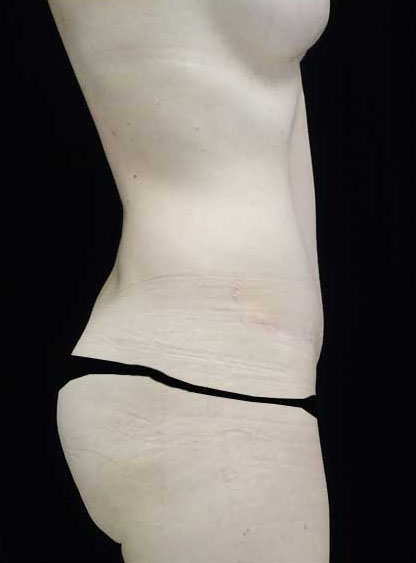 Tummy Tuck Before & After Patient #15062