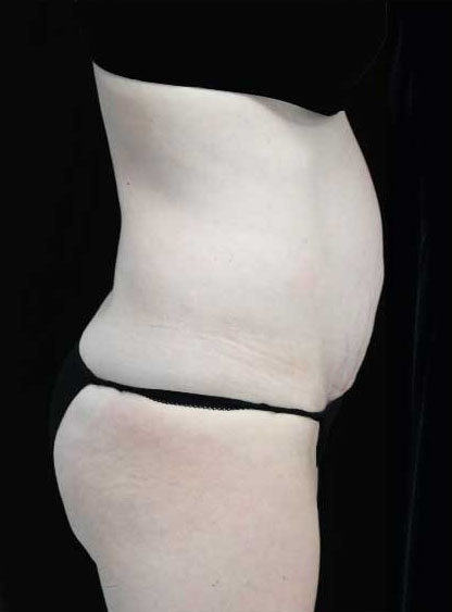 Tummy Tuck Before & After Patient #15062
