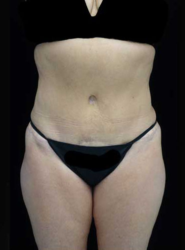 Tummy Tuck Before & After Patient #15085