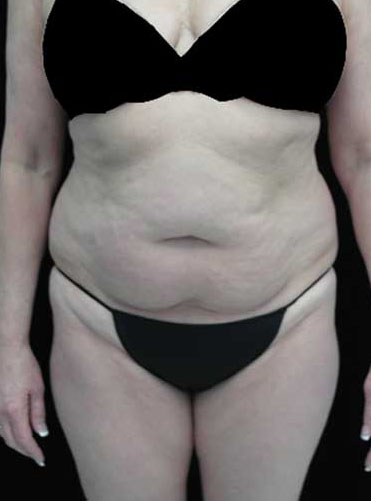 Tummy Tuck Before & After Patient #15085