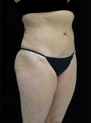 Tummy Tuck Before & After Patient #15085