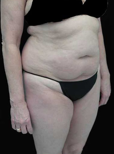 Tummy Tuck Before & After Patient #15085