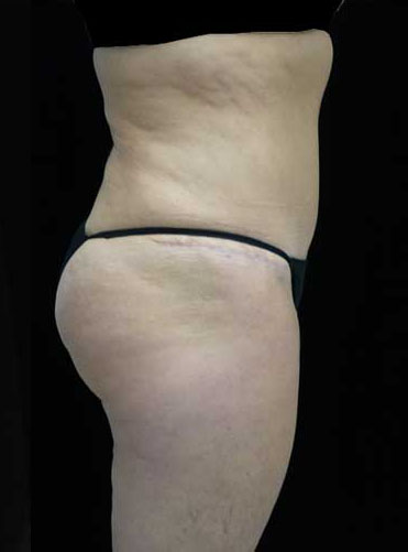 Tummy Tuck Before & After Patient #15085